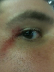 My first BJJ eye injury -- Cut along the fold of the eyelid.